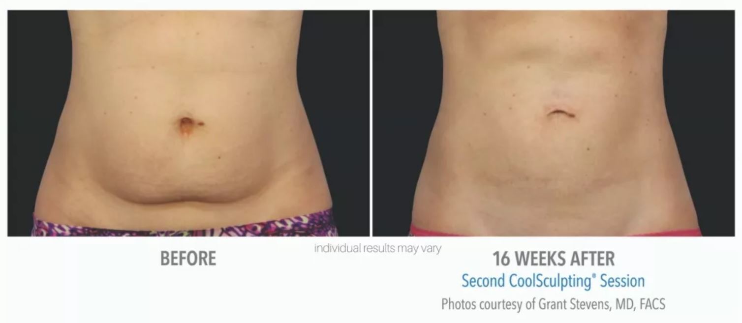 coolsculpting-before-and-after-1