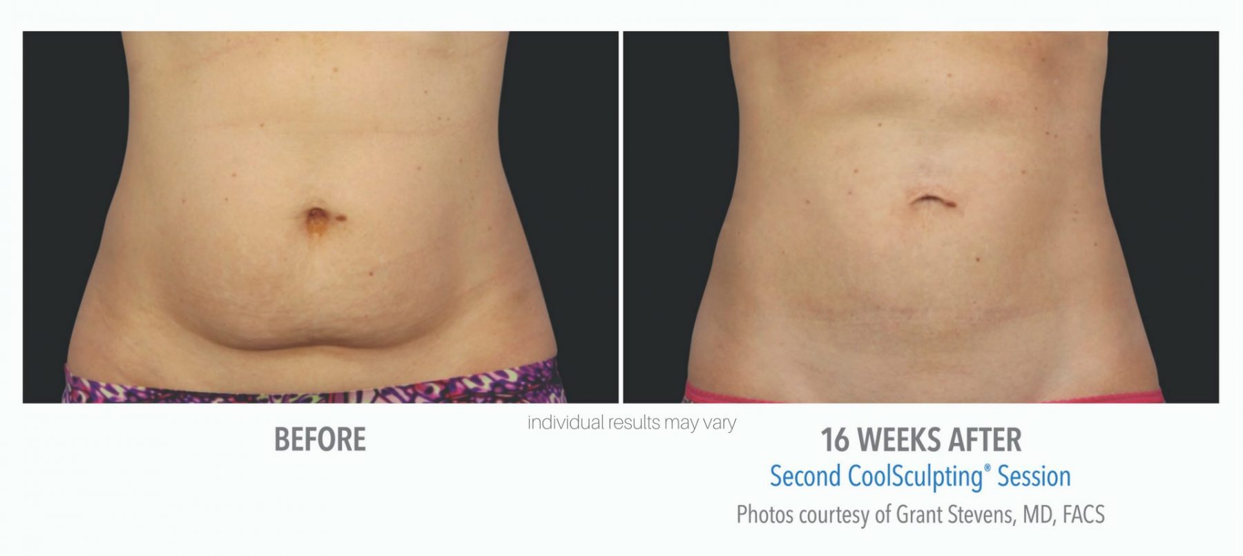 coolsculpting-before-and-after-3