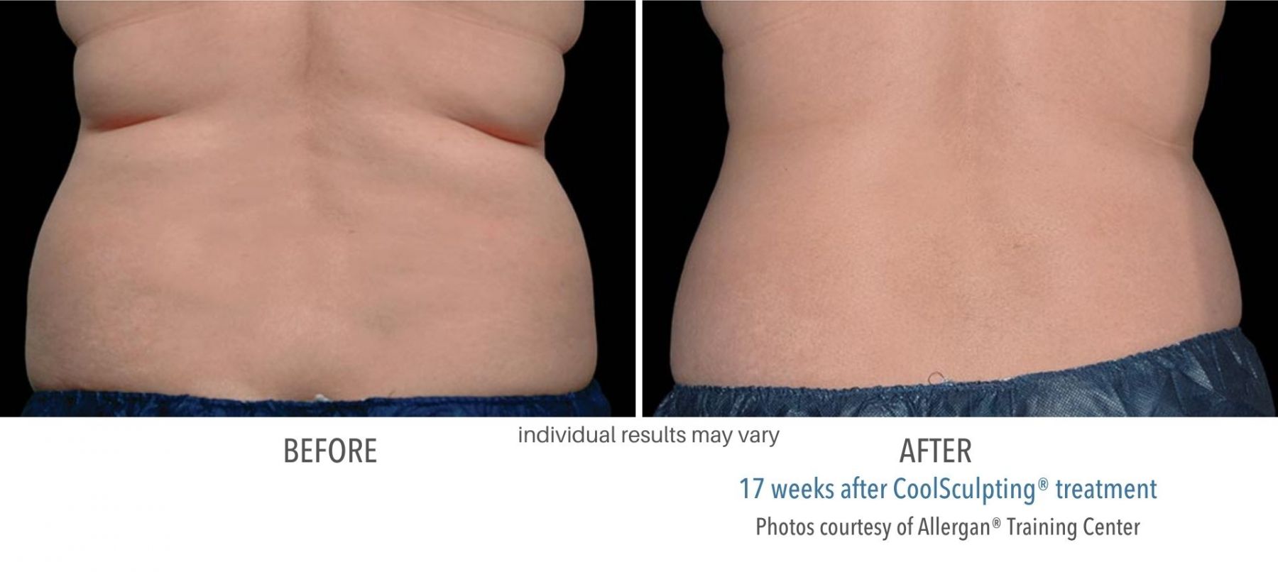 coolsculpting-before-and-after-4