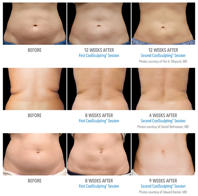 coolsculpting-before-and-after-6