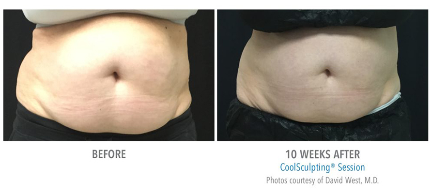 coolsculpting-before-and-after-7