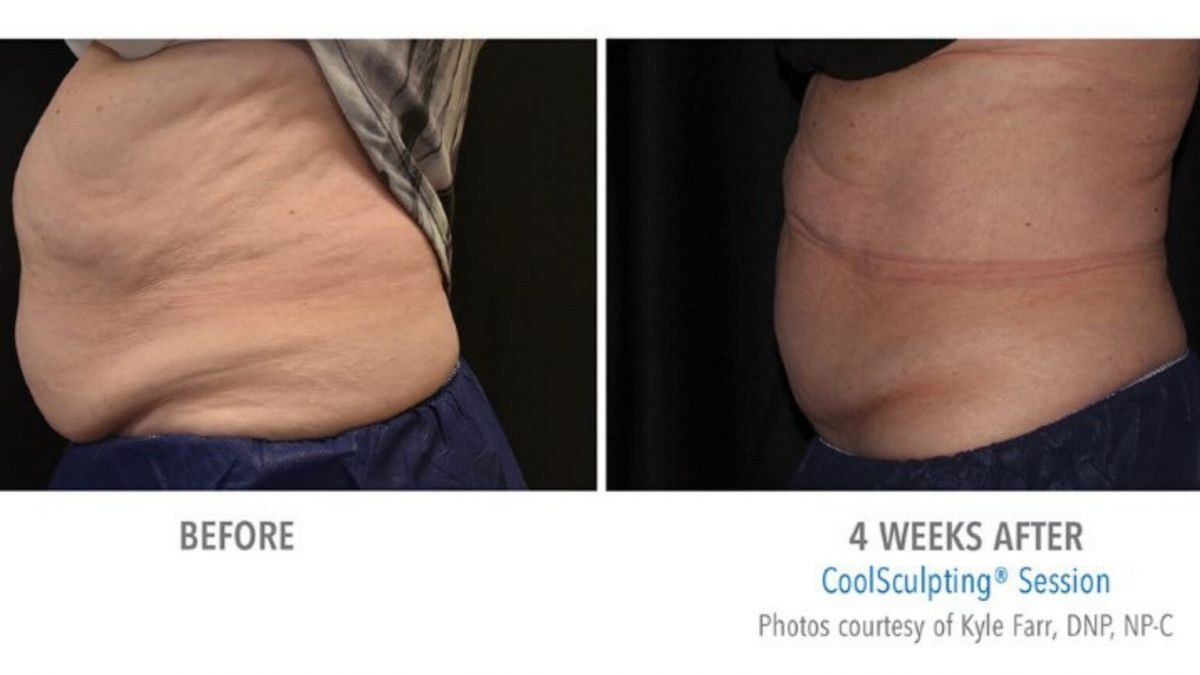 coolsculpting-before-and-after-8