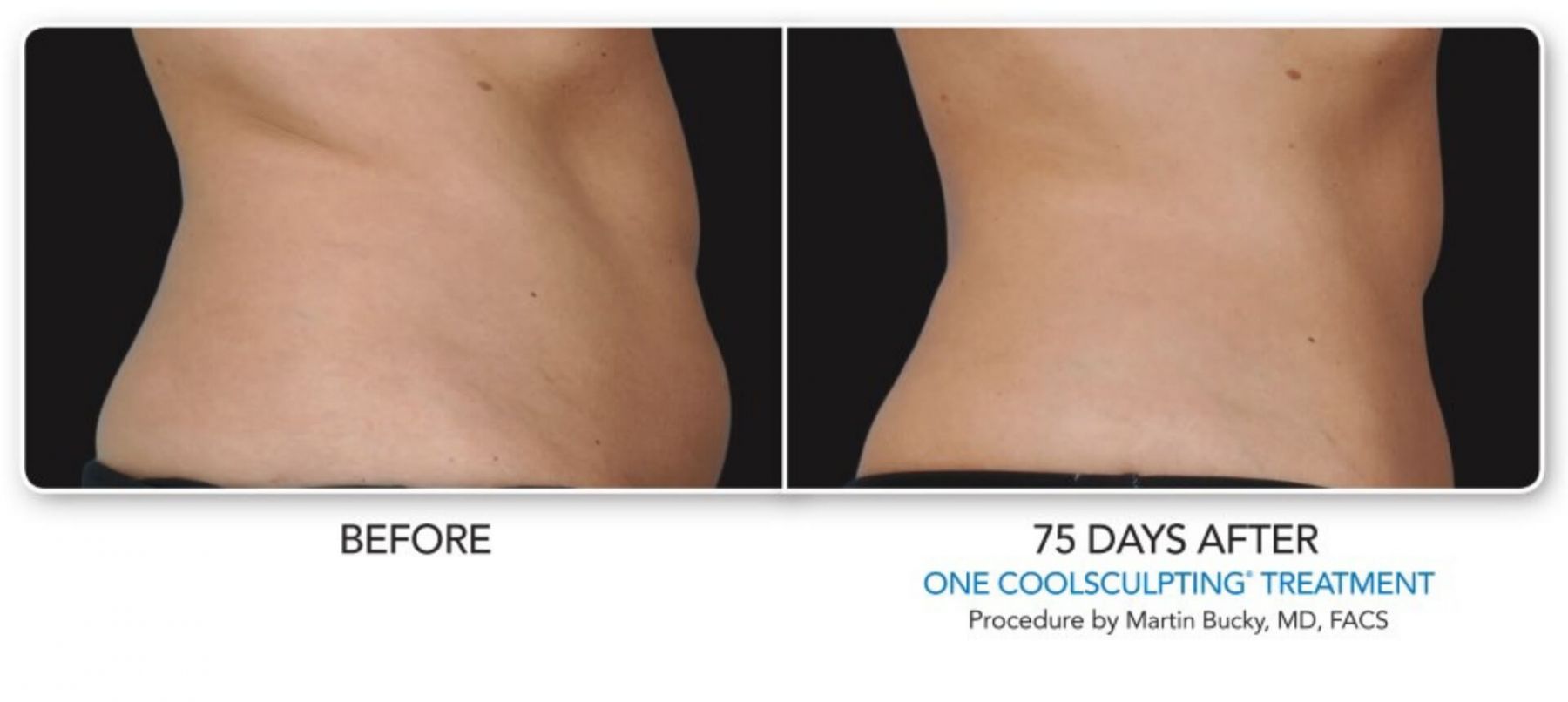 coolsculpting-before-and-after-9