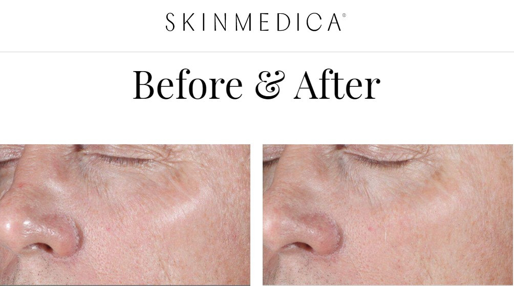 SkinMedica-before-after-2