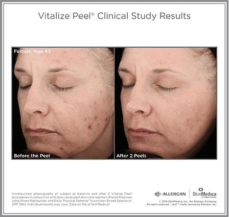 SkinMedica-before-after-Vitilize