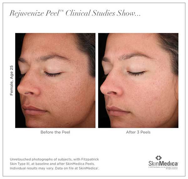 SkinMedica-before-after-rejuvenize