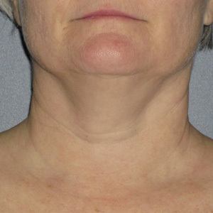 Ultherapy-0024-0086W_0Day_BEFORE_Neck1_low-res