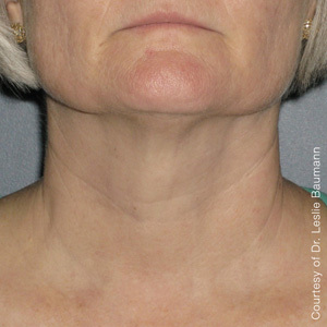 Ultherapy-0024-0086W_180Day_1TX_AFTER_Neck1_low-res