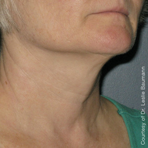 Ultherapy-0024-0086W_180Day_1TX_AFTER_Neck2_low-res