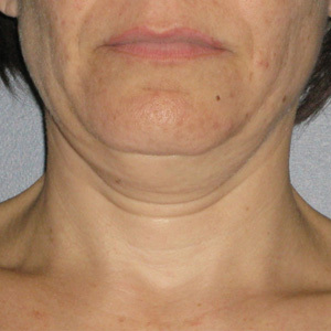 Ultherapy-0026-0086W_0Day_BEFORE_Neck1_low-res