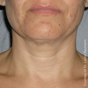 Ultherapy-0026-0086W_180Day_1TX_AFTER_Neck1_low-res