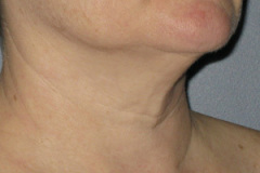 Ultherapy-0024-0086W_0Day_BEFORE_Neck2_low-res