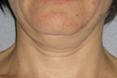 Ultherapy-0026-0086W_0Day_BEFORE_Neck1_low-res