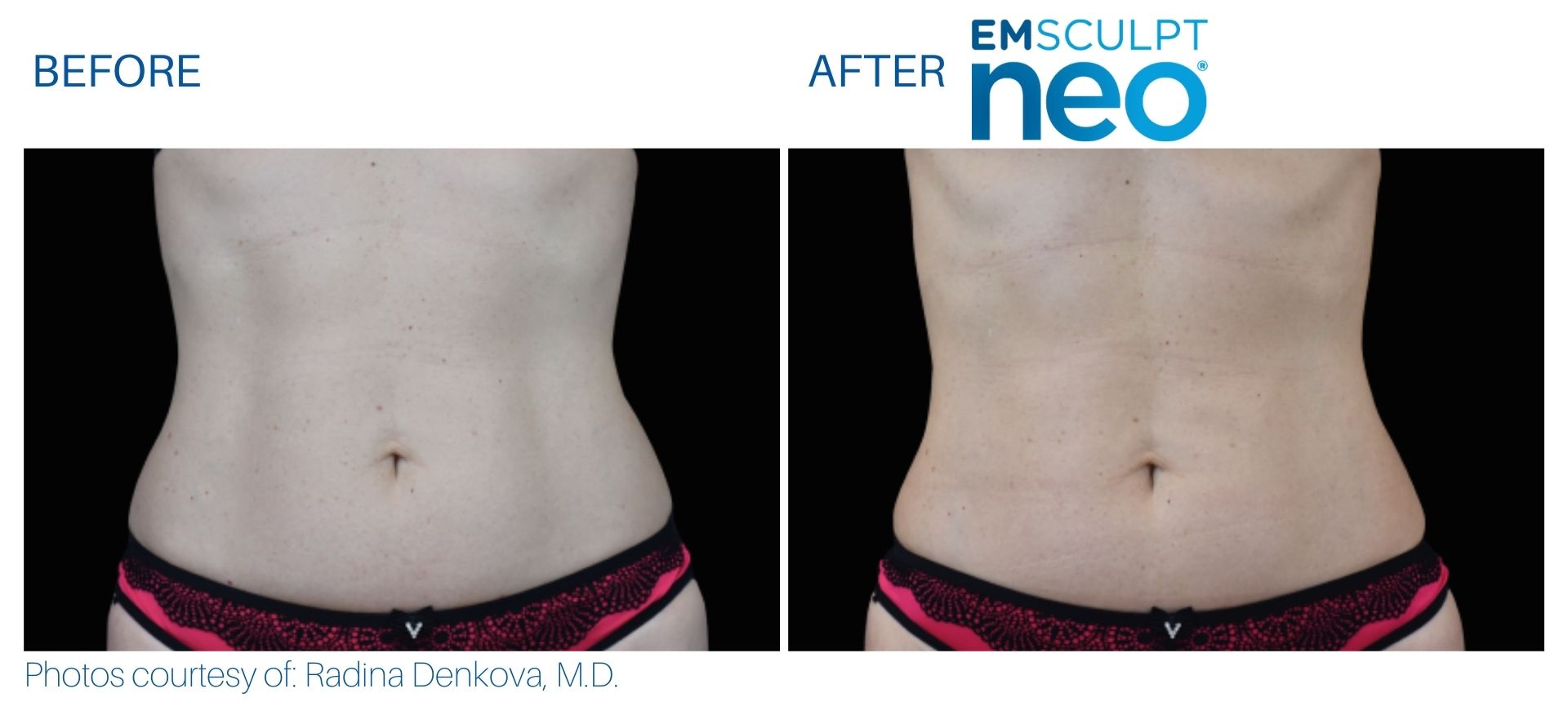 Emsculpt Neo® is a revolutionary body sculpting treatment that has